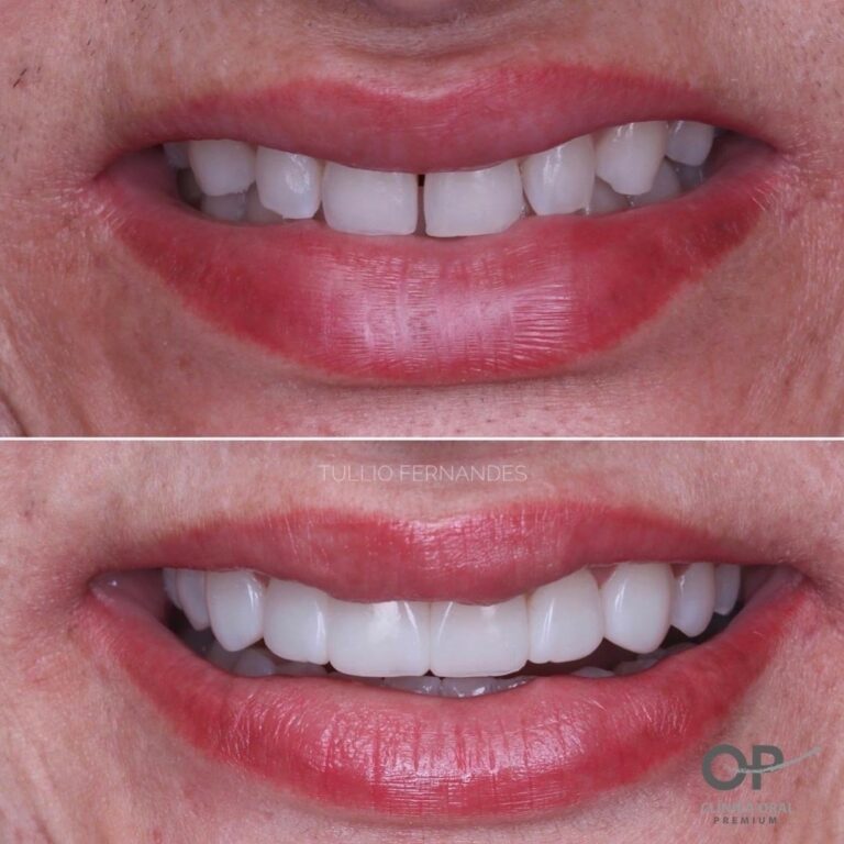 Facetas Em Resina Cl Nica Oral Premium