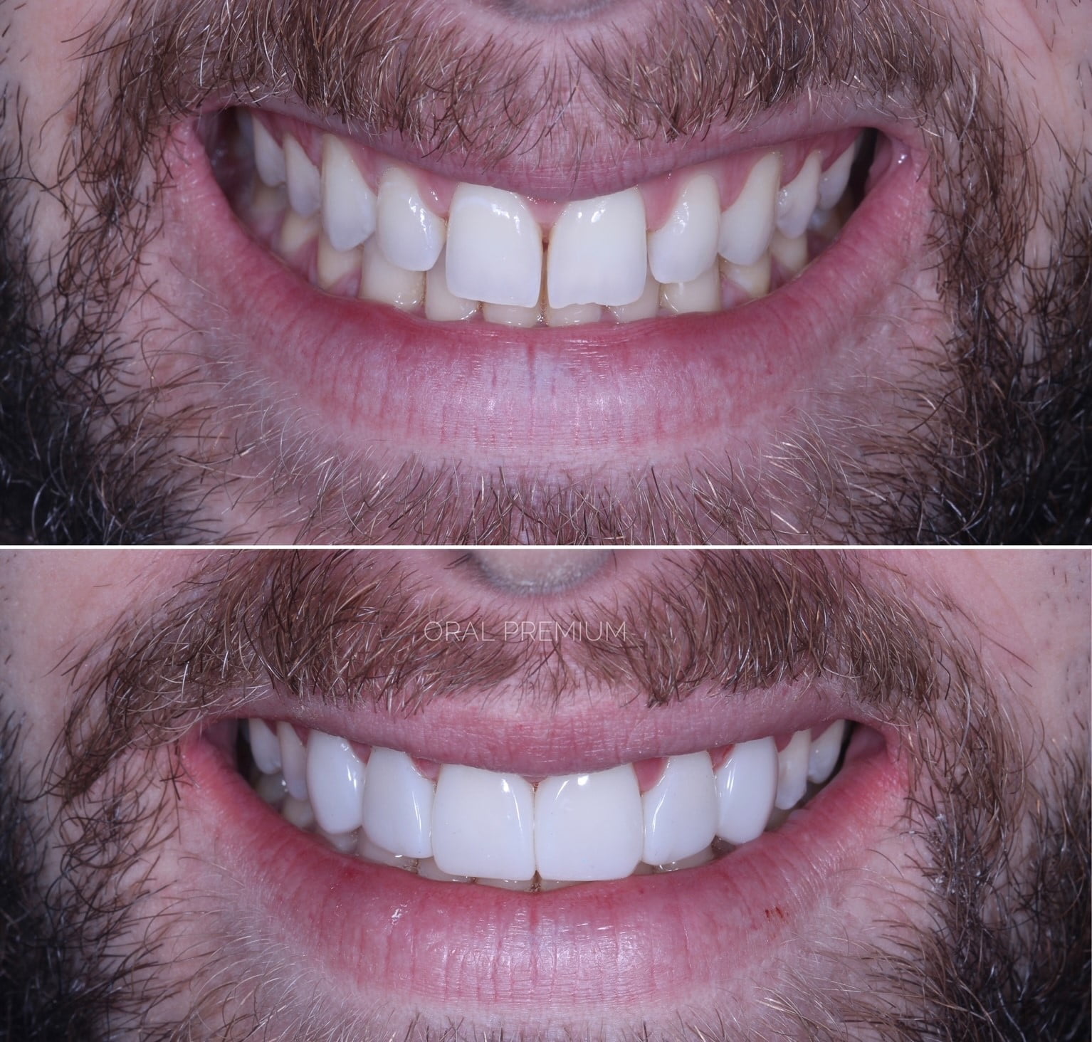 Sorriso Transformado Facetas Em Resina Cl Nica Oral Premium