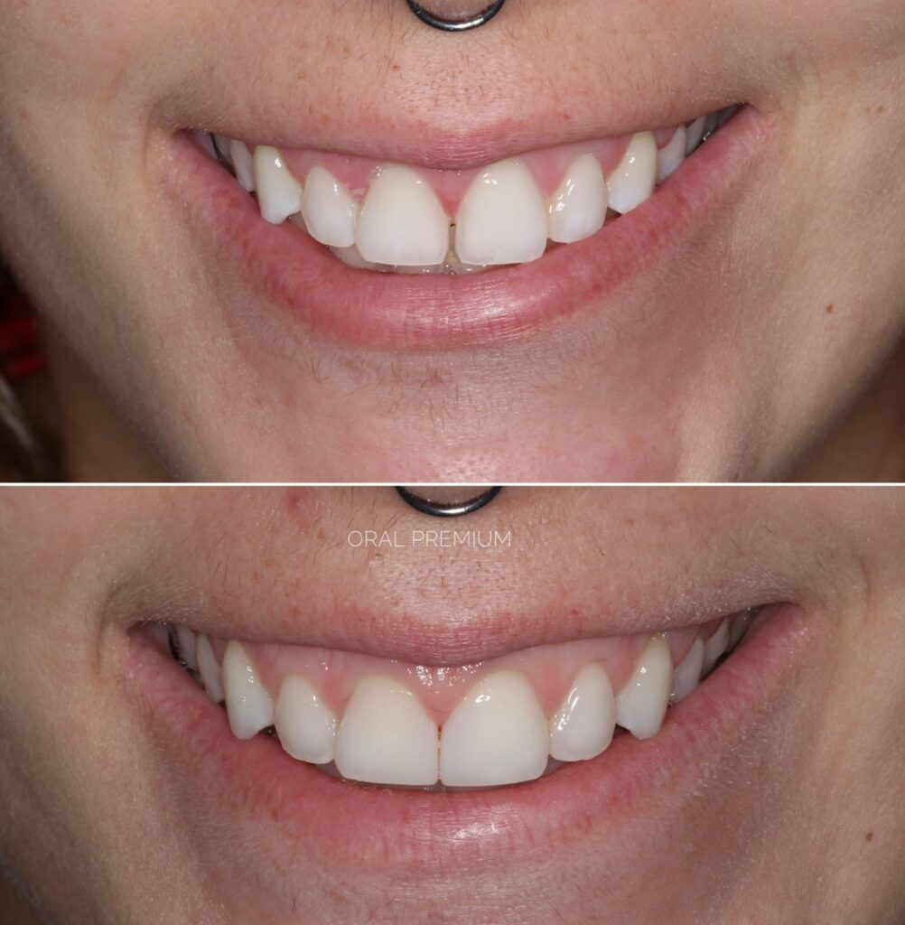 Fechamento De Diastema Com Resina Composta - Clínica Oral Premium